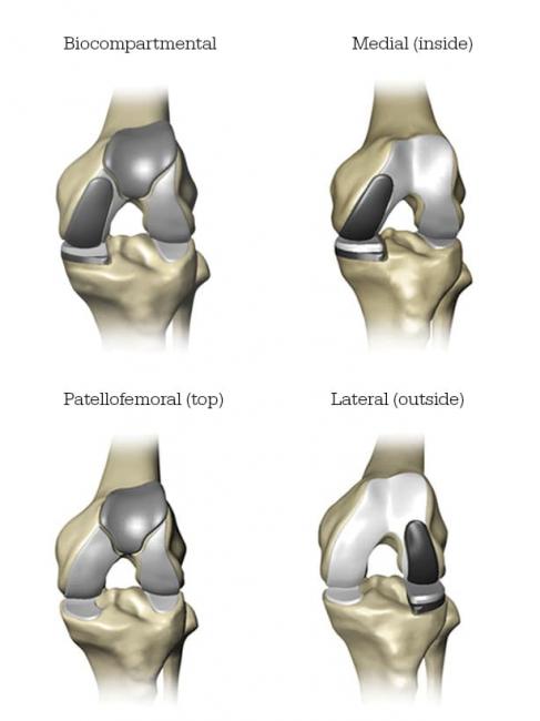 knee replacement views