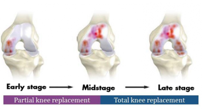 knee replacement timeline