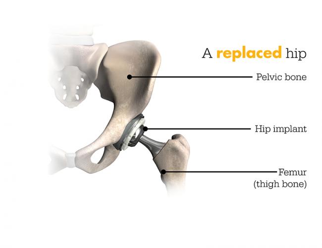 replaced hip